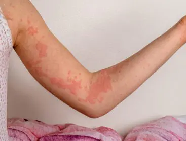 Chronic hives