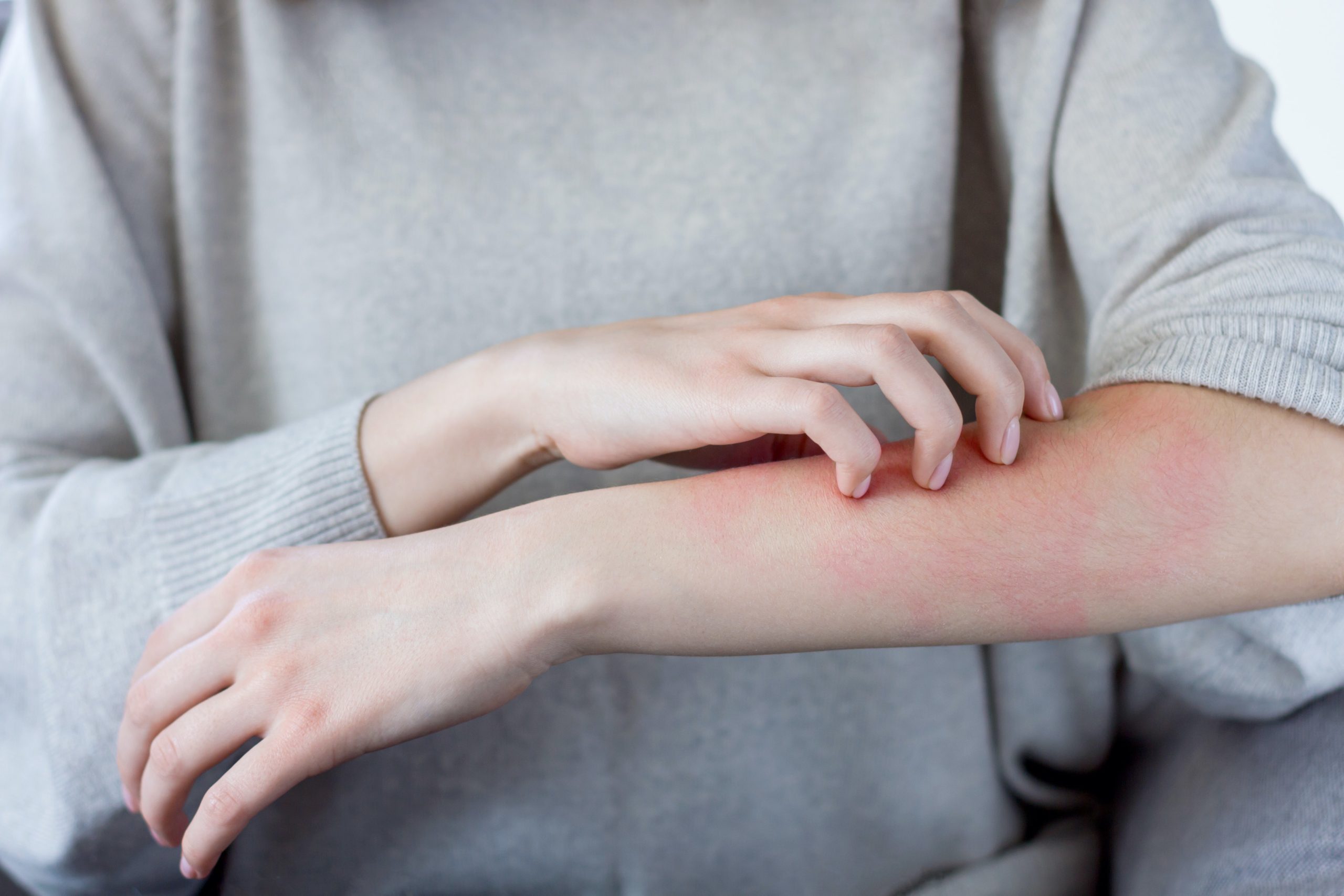 How to Identify Skin Allergies and Treat Them in Time