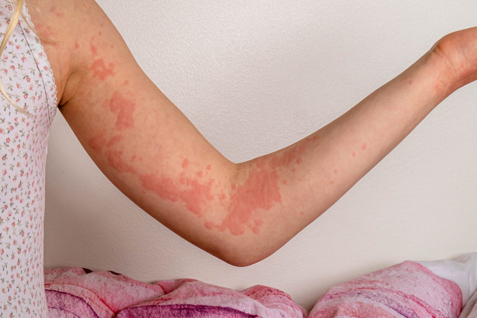 Chronic Spontaneous/Idiopathic Urticaria (Chronic Hives)